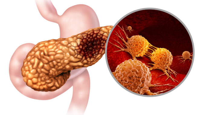 Scientists-Reveal-Possible-Early-Warning-Sign-of-Pancreatic-Cancer.jpg