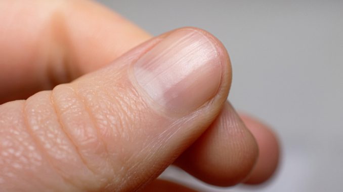 Woman-Had-‘Mark-on-Her-Nail-for-10-Years-Before.jpg